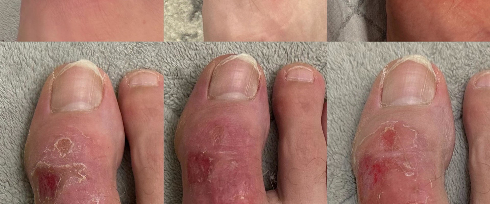 Normal Burn Pattern Skeleton second degree burns