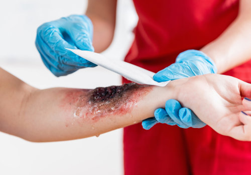 Burn Degree Chart Explained: Spot Burn Severity & Act Fast
